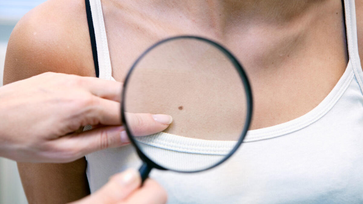 ANZIO - Visite gratuite per la prevenzione del melanoma della pelle. - 