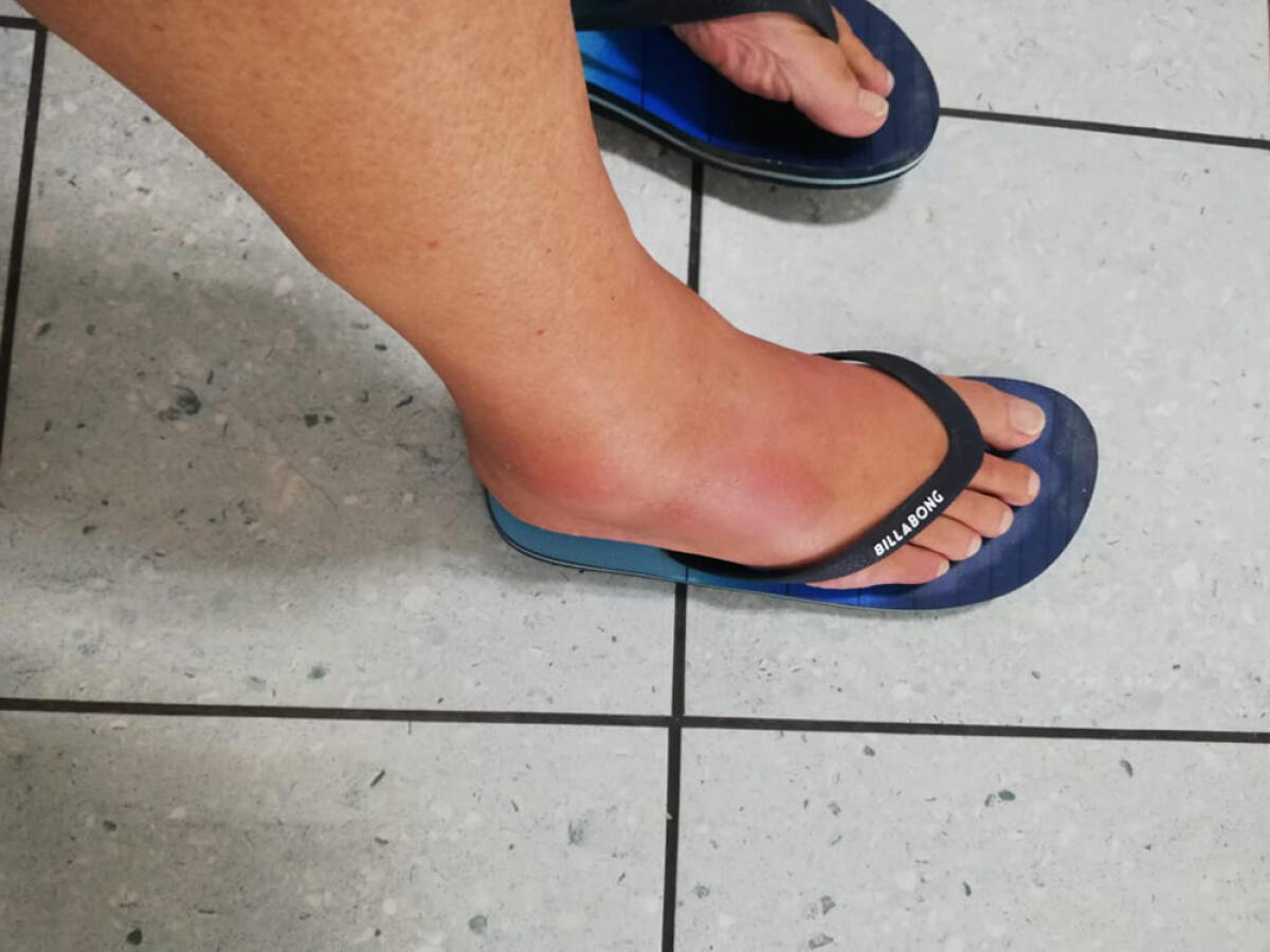 Marciapiedi in stato disastroso ad Aprilia: al pronto soccorso record di accessi per infortuni. L'assessore Caporaso: "raccoglieremo le segnalazioni ed interverremo". - 