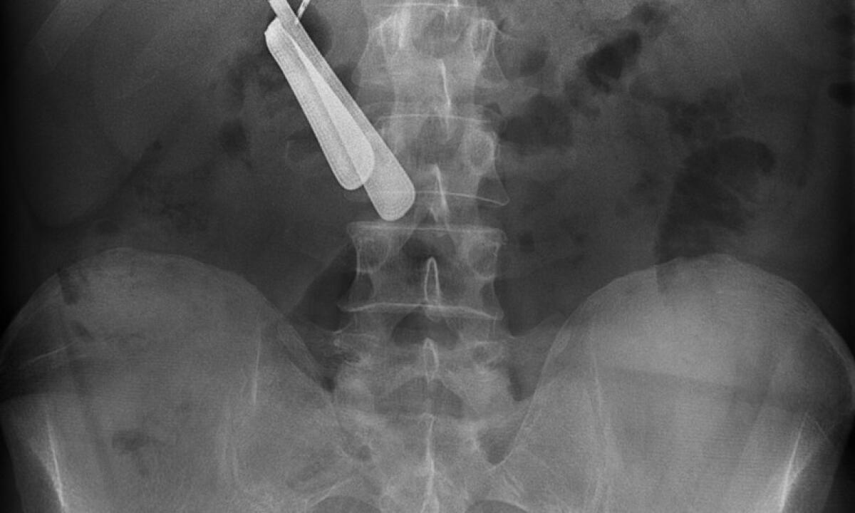 Punte di trapano, batterie e una forchetta nello stomaco: operato d’urgenza all’Icot di Latina. Ora sta bene - 