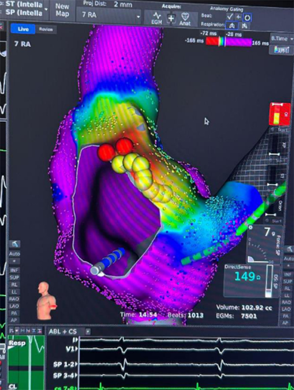 Mappaggio elettrico per monitorare la procedura di ablazione