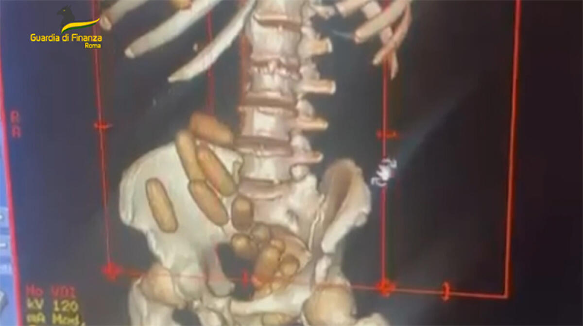 Ingerisce 280 grammi di cocaina in ovuli. “Corriere” arrestato dalla Guardia di Finanza del Comando Provinciale di Roma. - 