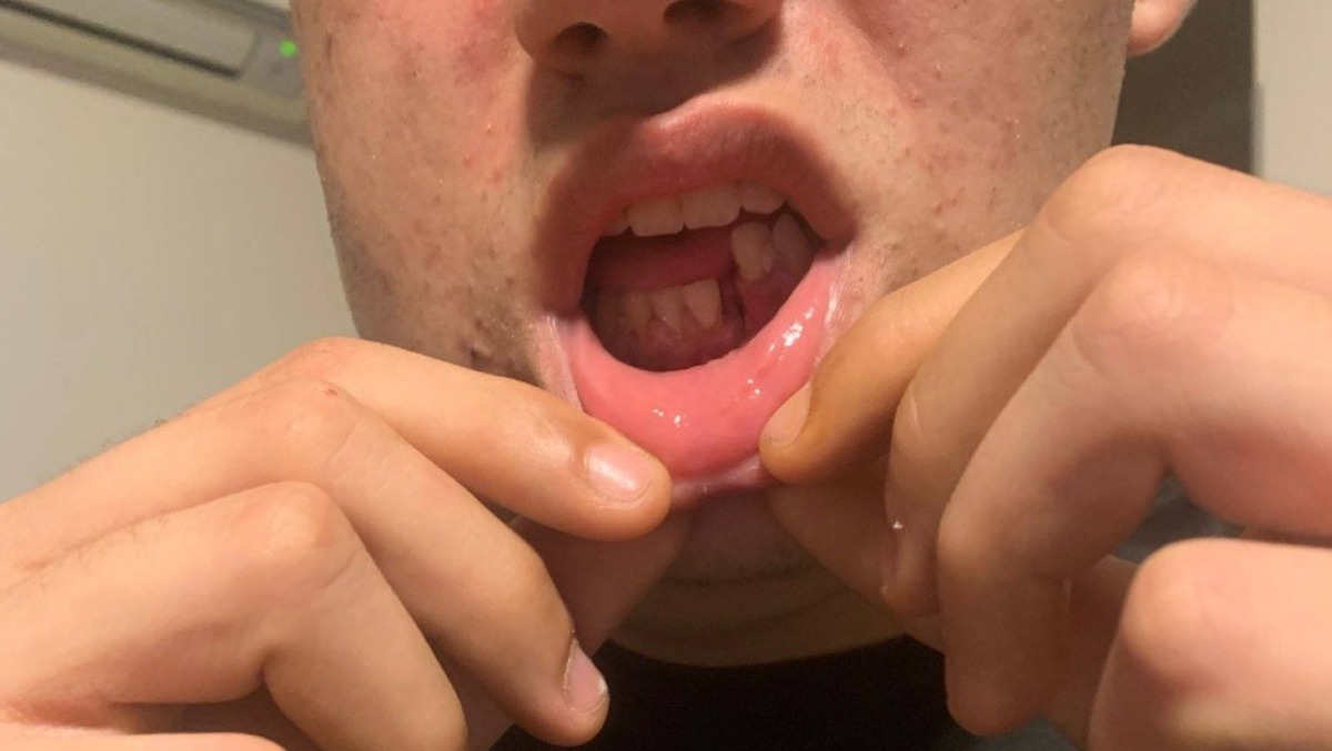 17enne di Aprilia aggredito brutalmente, i Carabinieri conducono in carcere un 25enne. - 